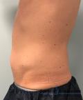 CoolSculpting®: Patient 13 - After 