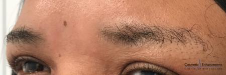 Microblading: Patient 2 - Before and After Image 2
