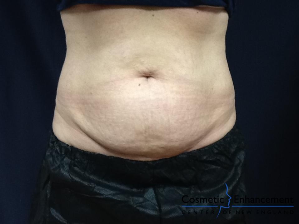 CoolSculpting®: Patient 26 - Before and After 2
