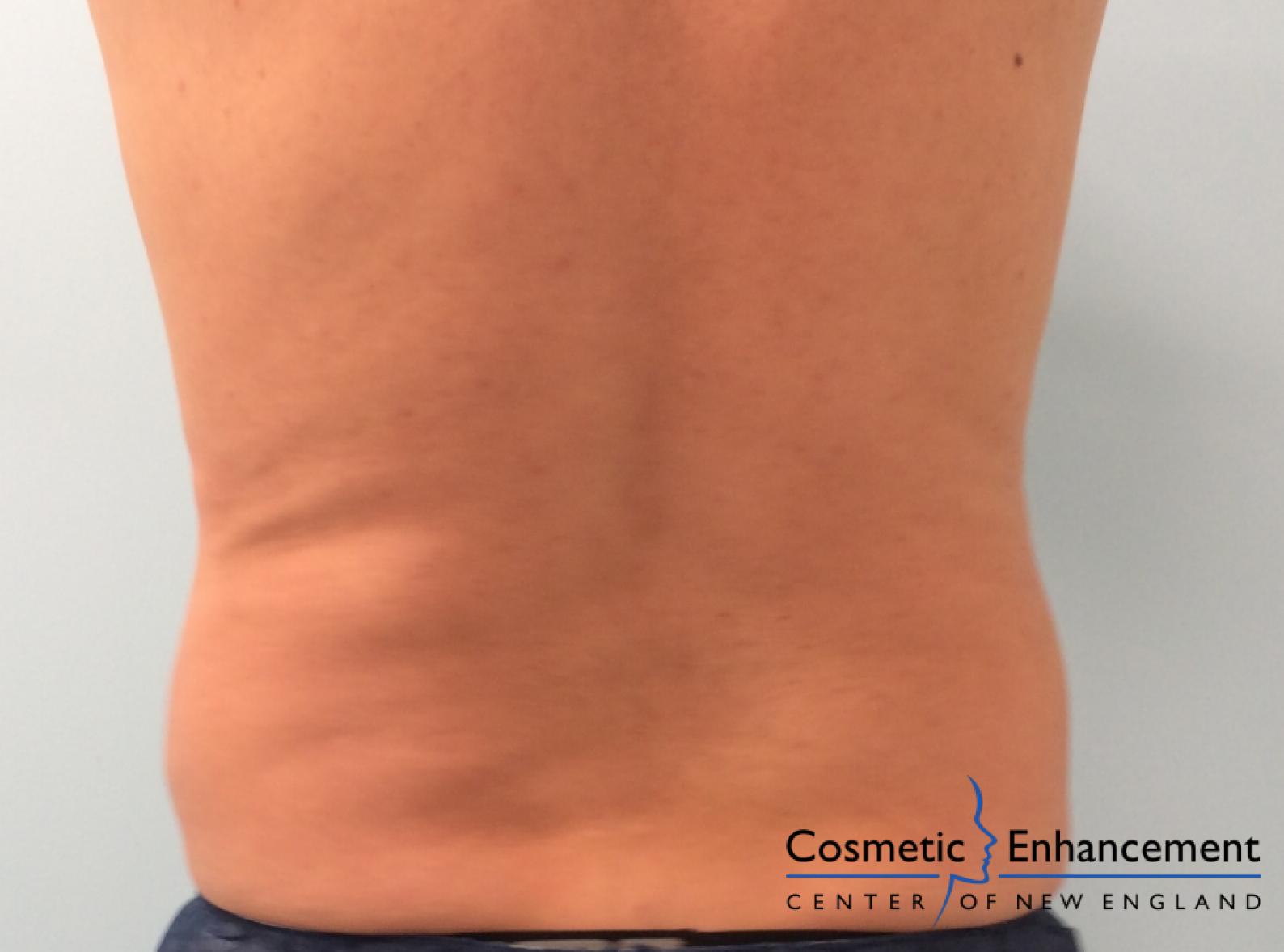 CoolSculpting®: Patient 7 - After  