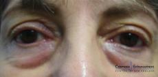 Sculptra: Patient 5 - Before 