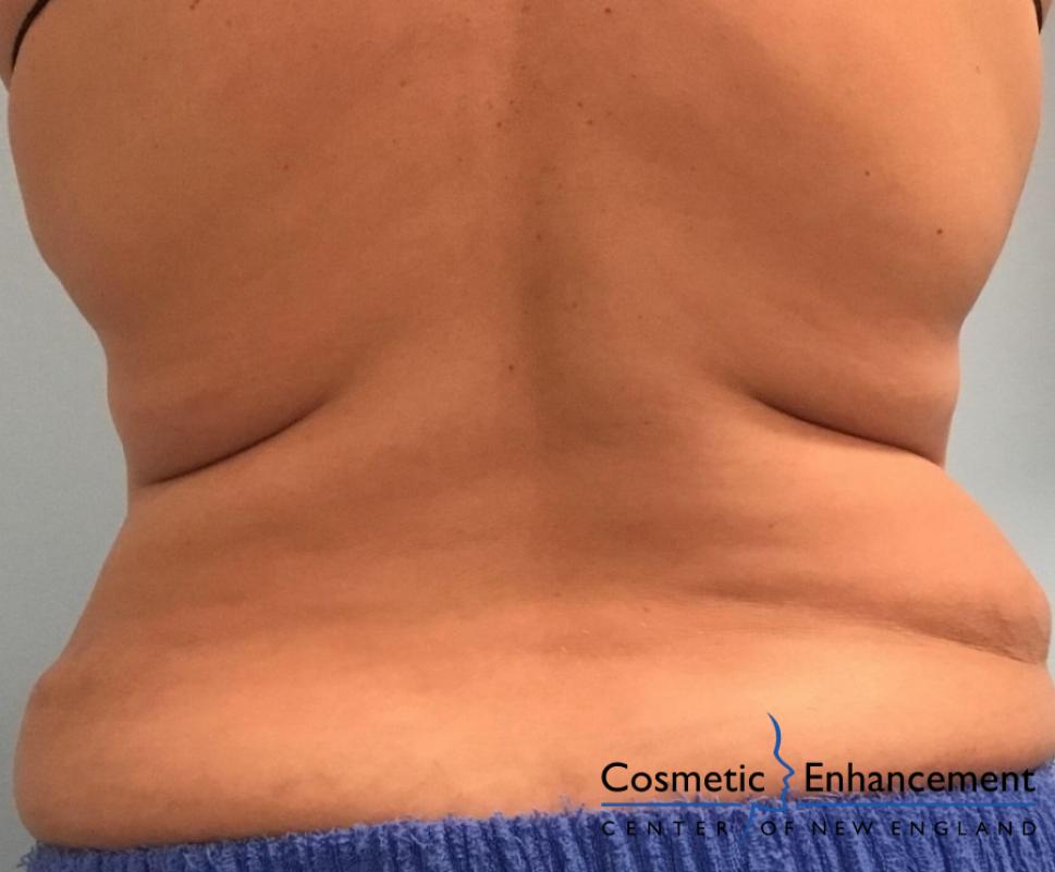 CoolSculpting®: Patient 12 - Before and After 2