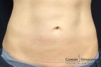 CoolSculpting®: Patient 1 - After 