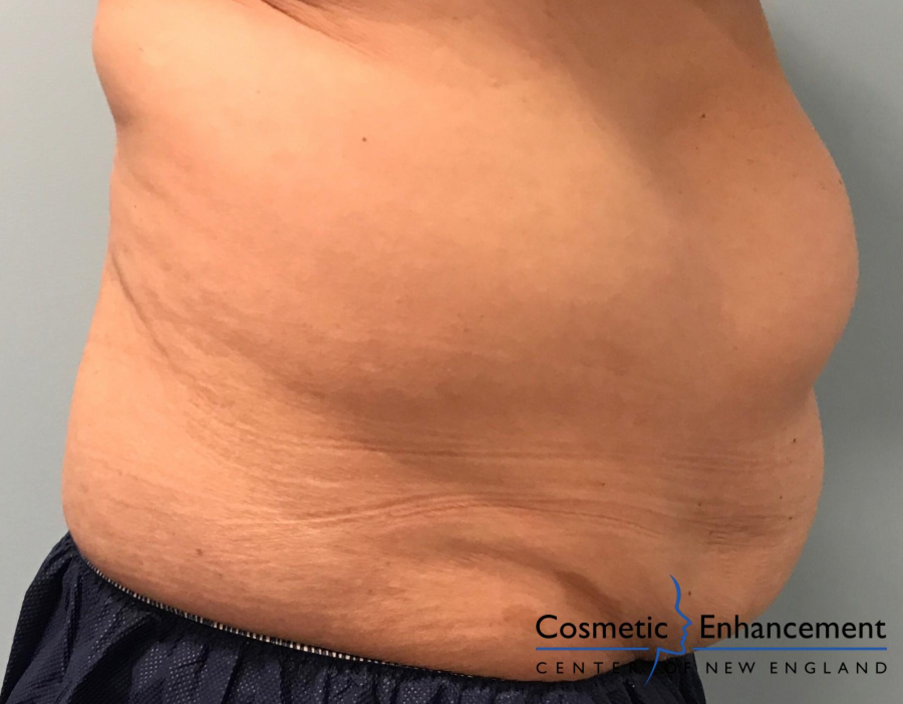 CoolSculpting®: Patient 14 - Before and After 3