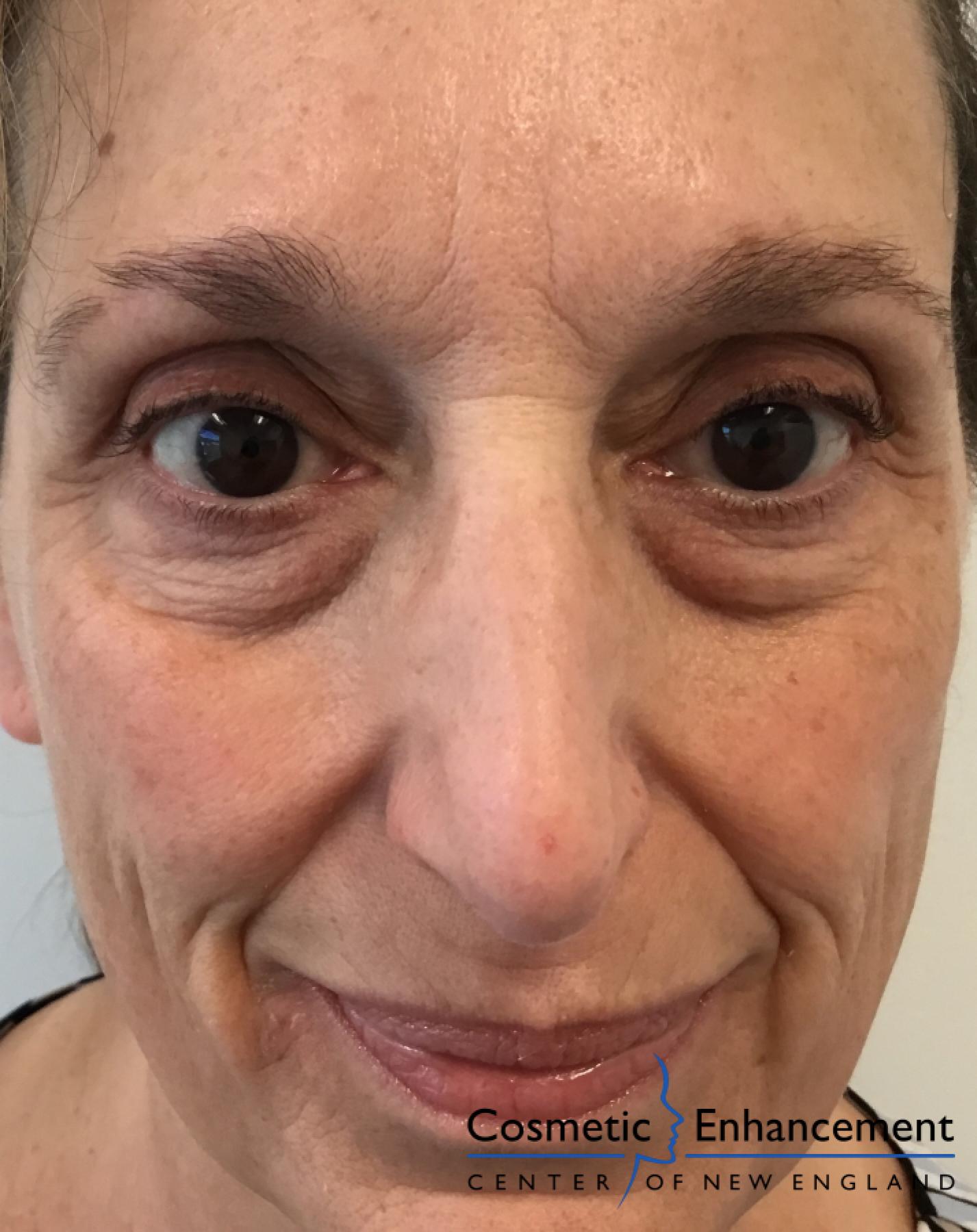 Fillers: Patient 3 - After  