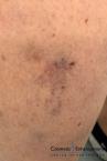 Sclerotherapy: Patient 1 - After Image 