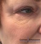 TotalFX: Patient 1 - Before 