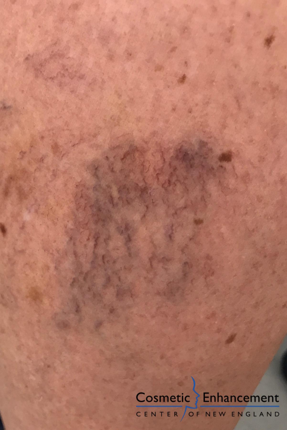 Sclerotherapy: Patient 1 - Before 