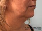 CoolSculpting®: Patient 19 - Before 