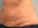 CoolSculpting®: Patient 11 - After 