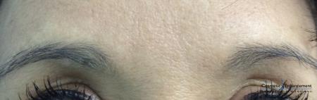 Ultherapy®: Patient 6 - After Image 1
