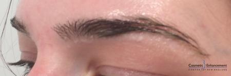 Microblading: Patient 1 - Before and After Image 3