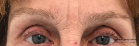 Microblading: Patient 5 - Before Image 1