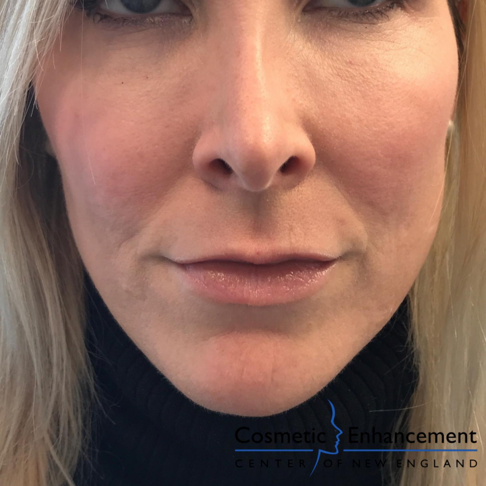 Fillers: Patient 4 - Before 