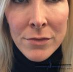 Fillers: Patient 4 - Before Image 