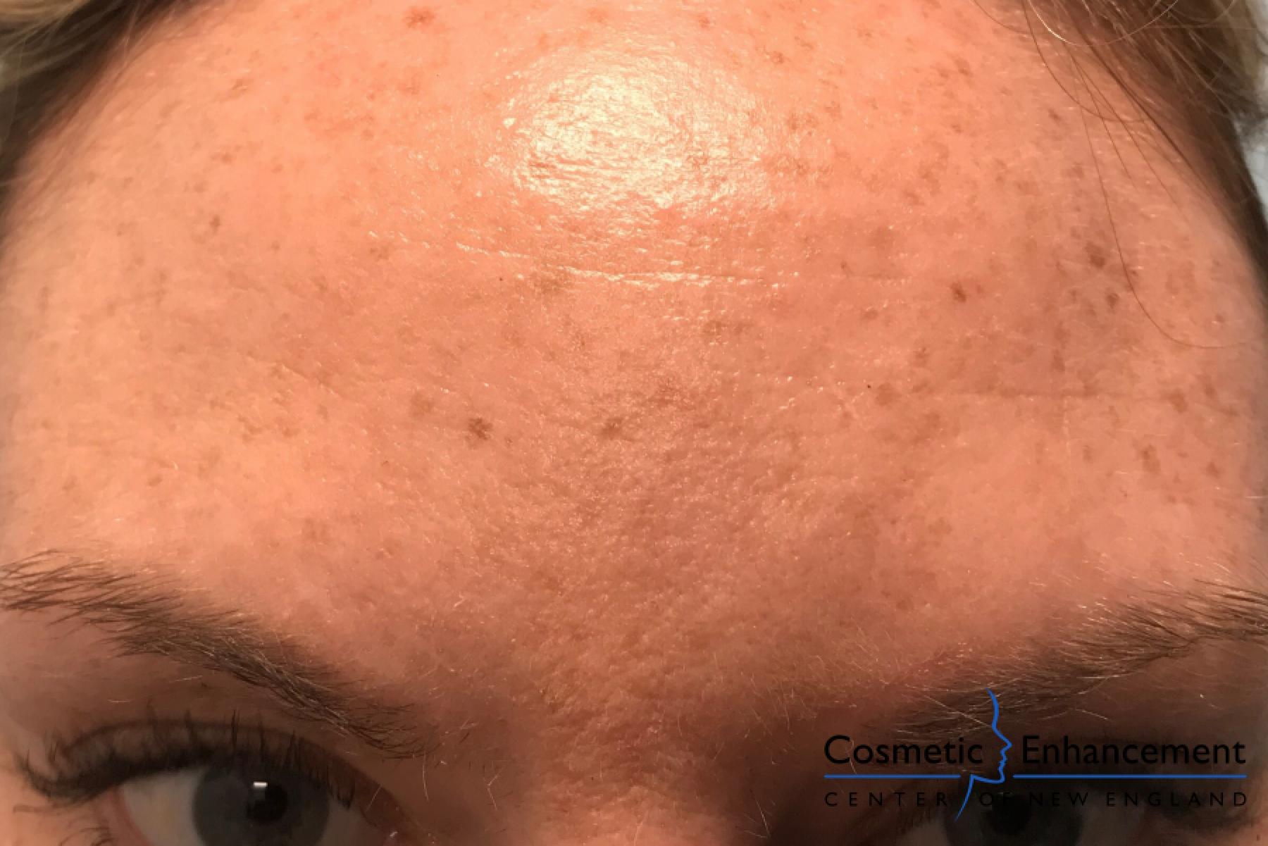 BOTOX® Cosmetic: Patient 3 - After  