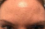 BOTOX® Cosmetic: Patient 3 - After 