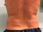 CoolSculpting®: Patient 20 - After 