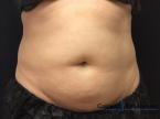 CoolSculpting®: Patient 21 - Before Image 