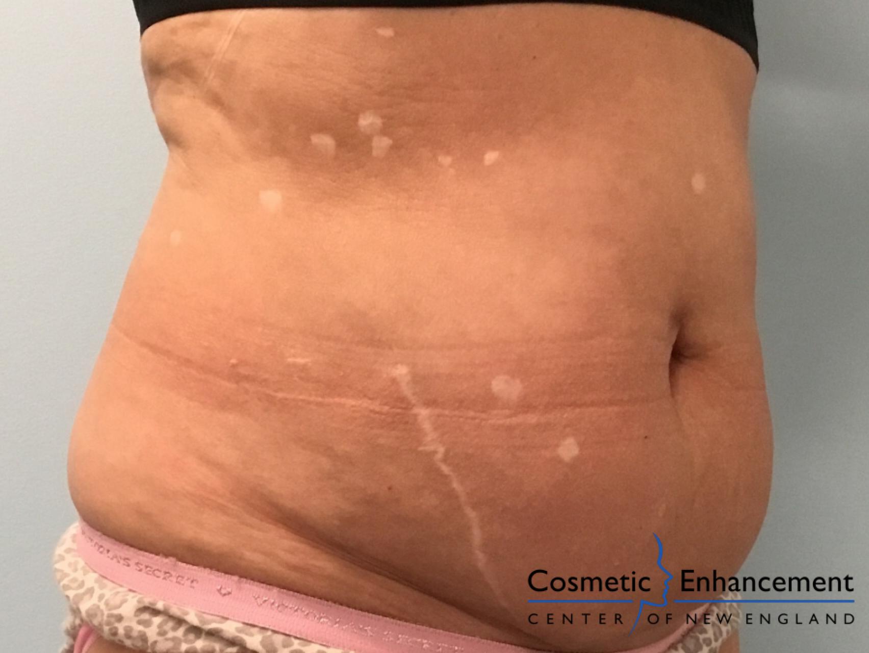 CoolSculpting®: Patient 23 - Before and After 2
