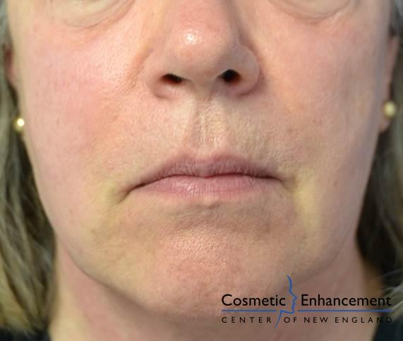 Sculptra: Patient 3 - After  