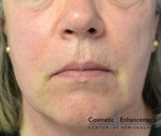 Sculptra: Patient 3 - After 