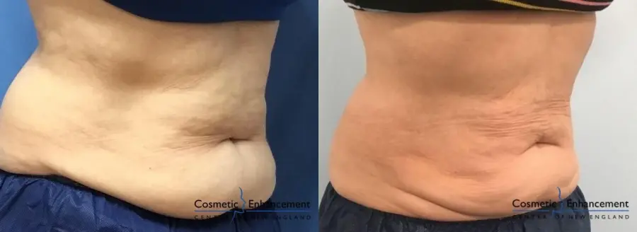 CoolSculpting®: Patient 16 - Before and After  