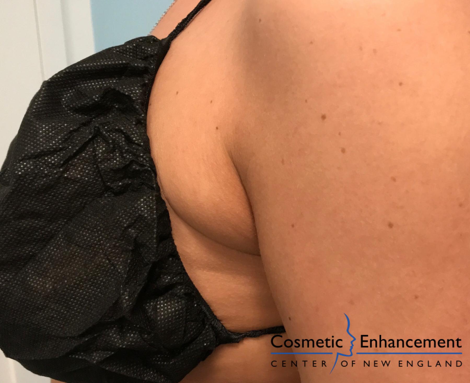 CoolSculpting®: Patient 2 - Before 1