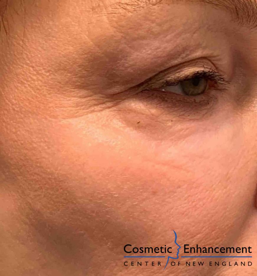 TotalFX: Patient 1 - After  
