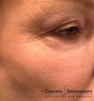 TotalFX: Patient 1 - After 