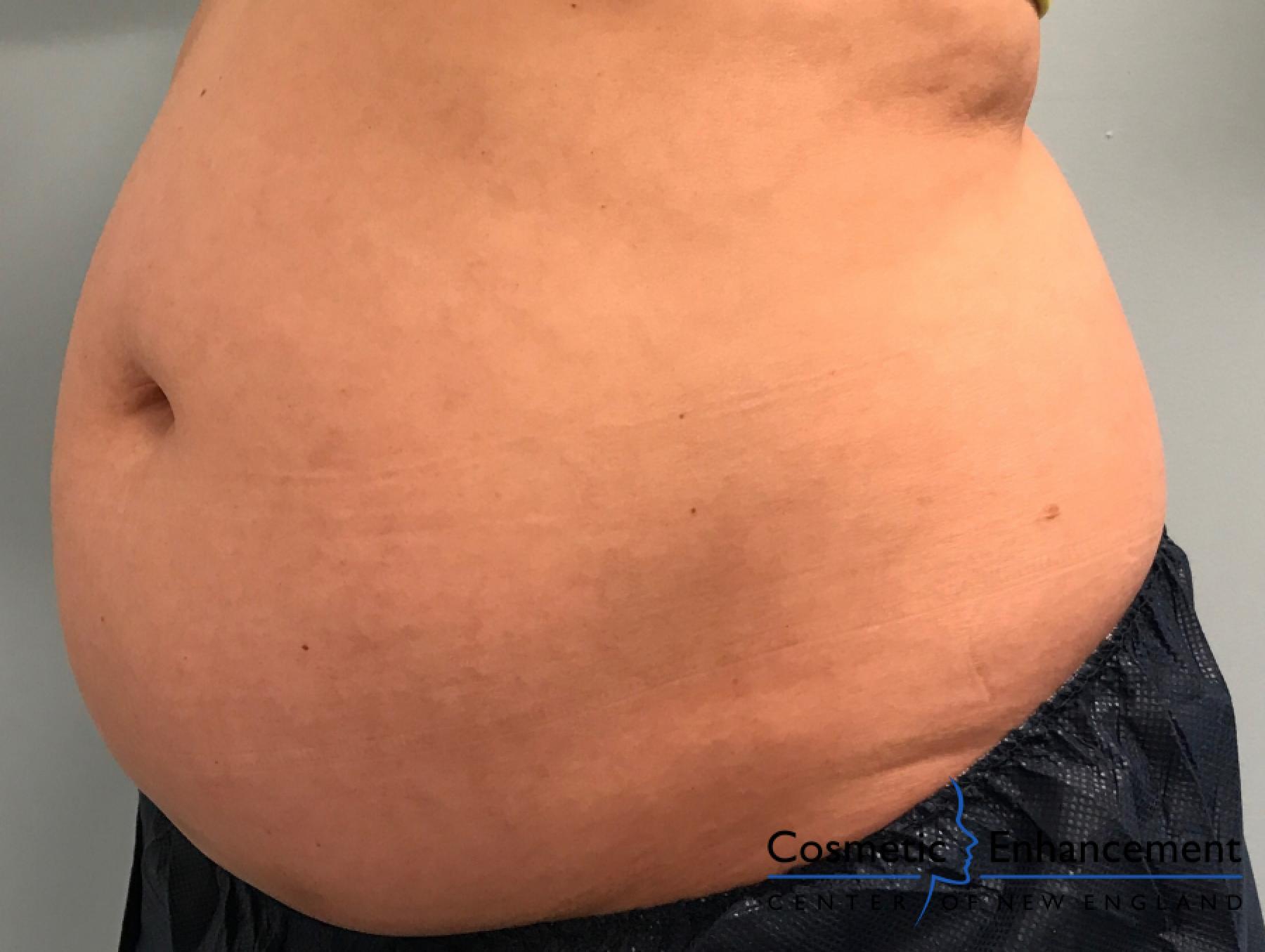 CoolSculpting®: Patient 5 - Before 1