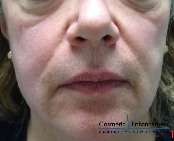 Sculptra: Patient 3 - After  