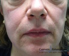 Sculptra: Patient 3 - Before 