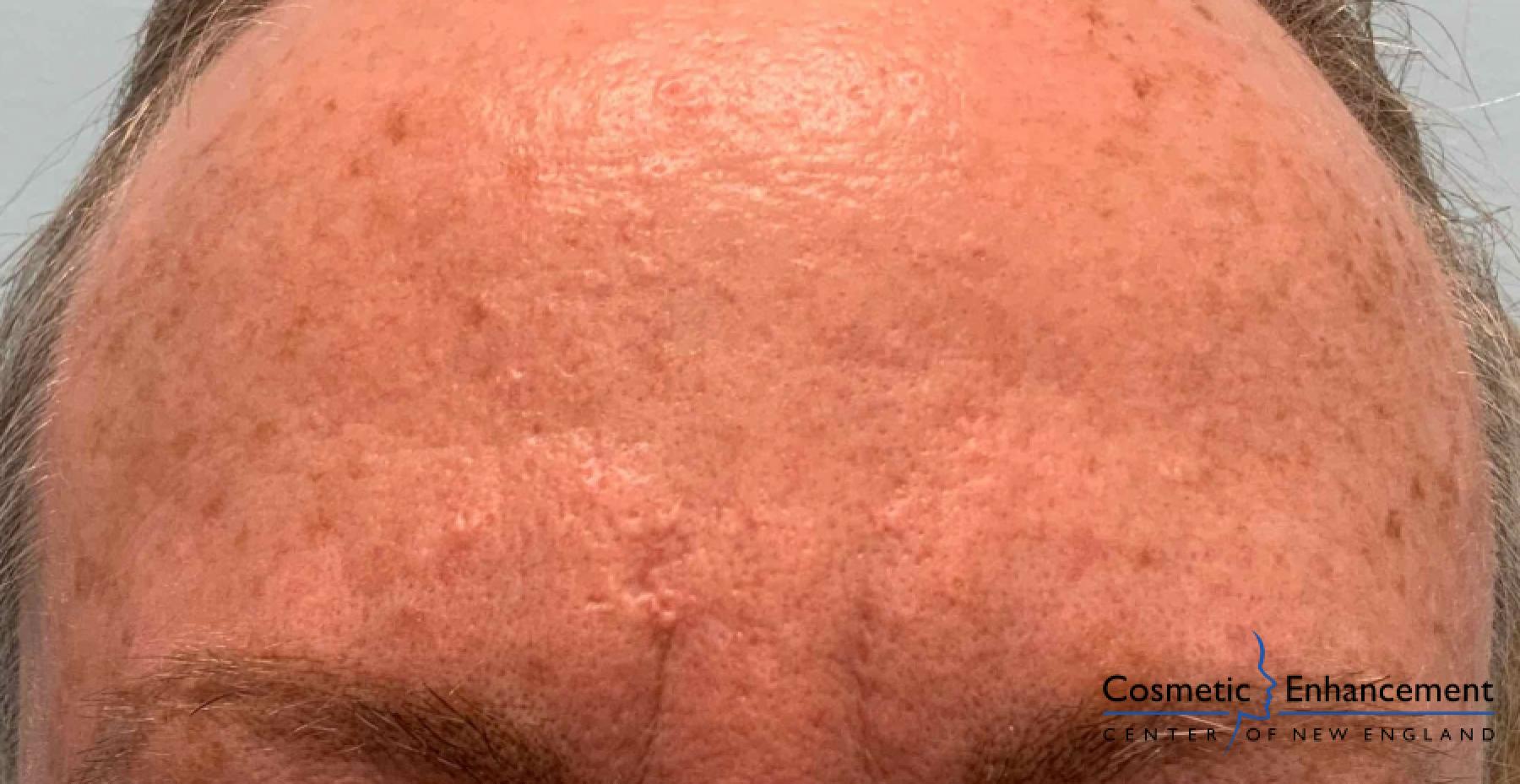 Smoothbeam: Patient 1 - After  
