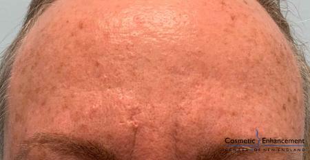 Smoothbeam: Patient 1 - After Image 1