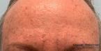 Smoothbeam: Patient 1 - After 