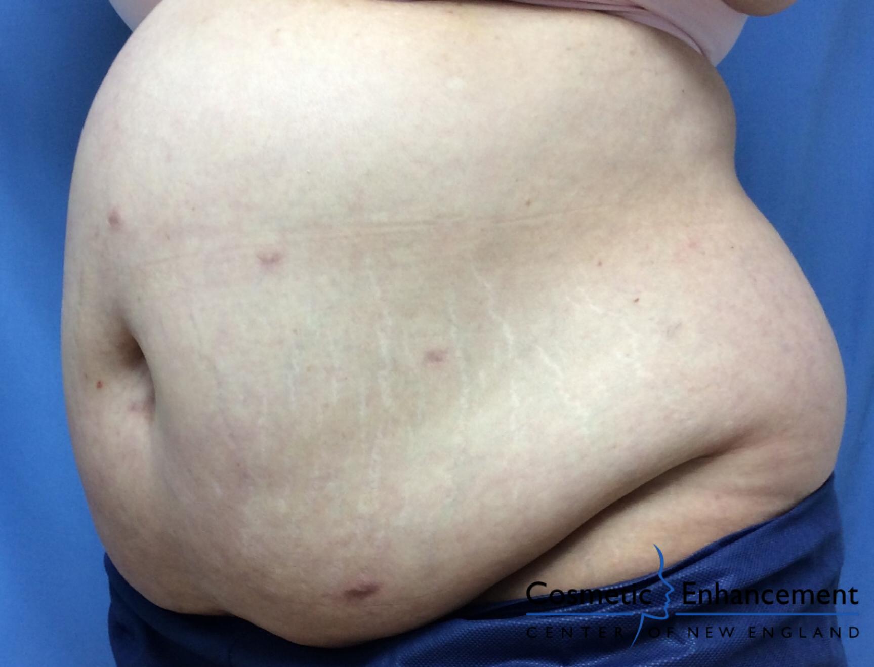CoolSculpting®: Patient 9 - After  