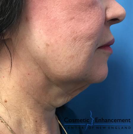 Profound: Patient 2 - Before Image 1