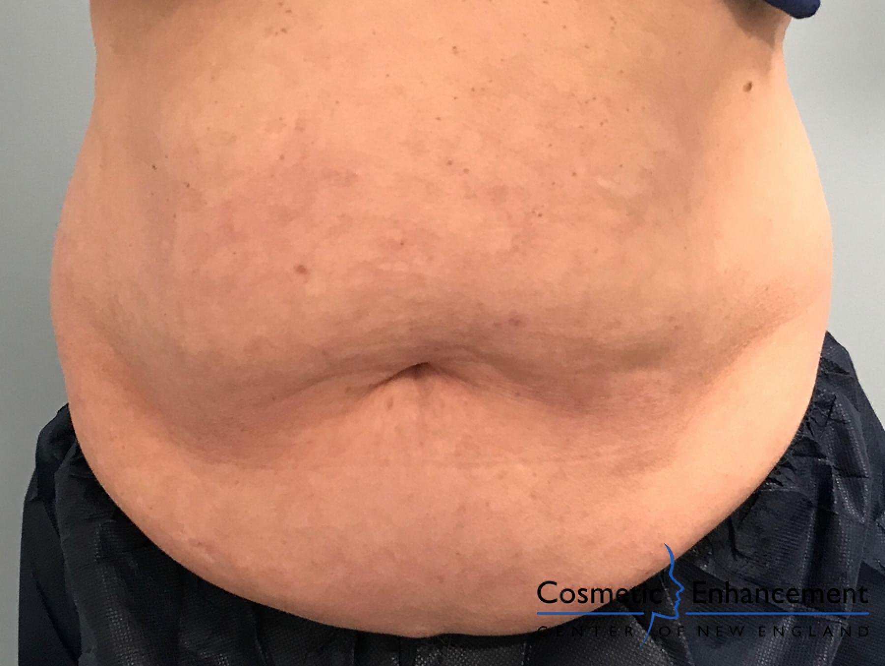 CoolSculpting®: Patient 4 - Before 1
