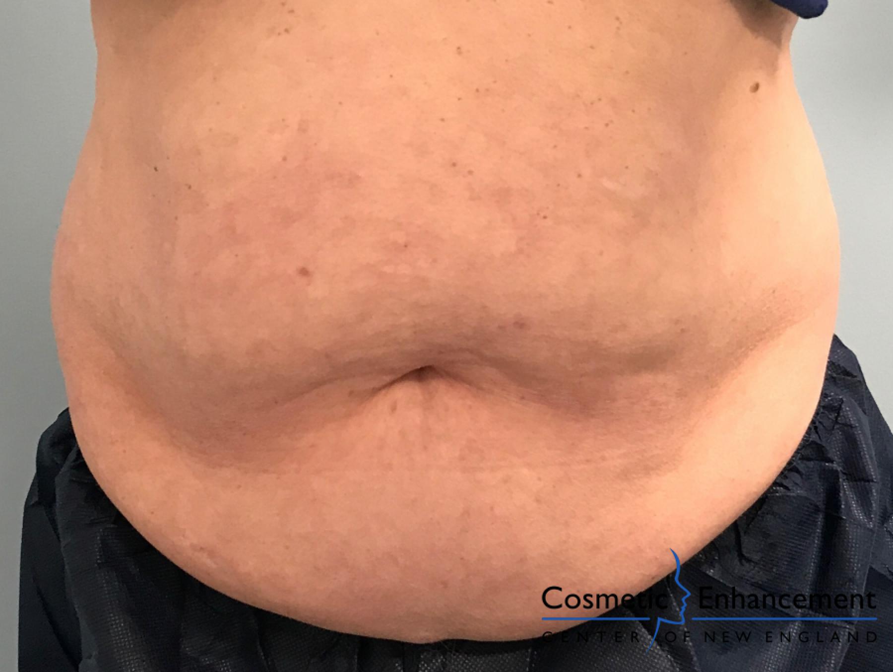 CoolSculpting®: Patient 4 - After  