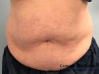 CoolSculpting®: Patient 4 - Before 