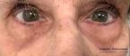 TotalFX: Patient 4 - After 
