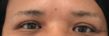 Microblading: Patient 2 - Before Image 1
