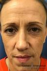 BOTOX® Cosmetic: Patient 7 - Before 