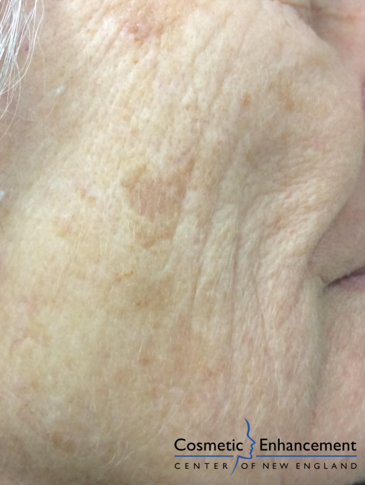 Trivantage - Age/Sun Spots: Patient 2 - After  