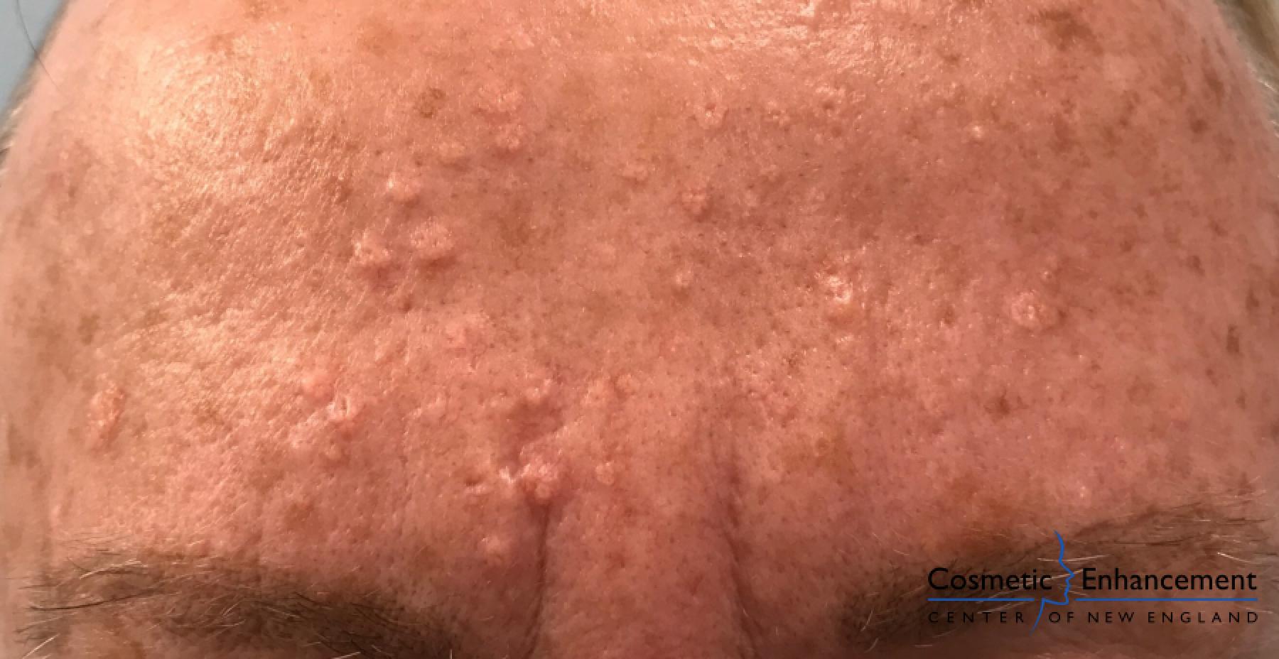 Smoothbeam: Patient 1 - After  