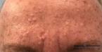 Smoothbeam: Patient 1 - Before 