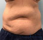 CoolSculpting®: Patient 14 - Before 
