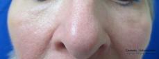 Sculptra: Patient 2 - After 
