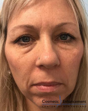 Voluma™ XC: Patient 1 - Before Image 1